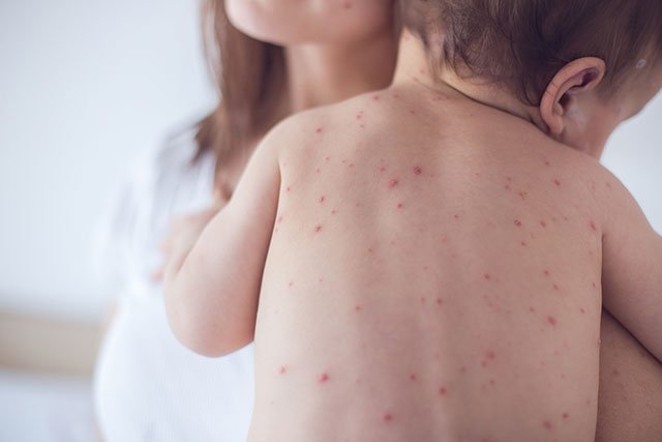 First Measles Case Reported in San Antonio by University Health System
